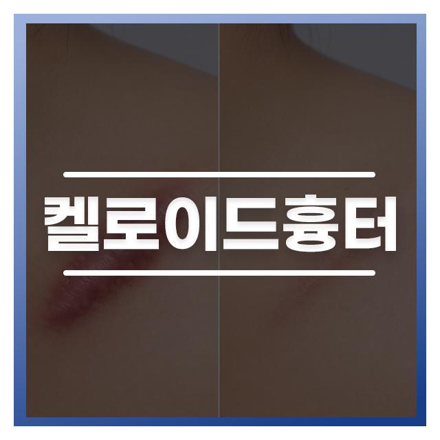 켈로이드흉터, 치료부터 관리까지 단단했더 조직이 부드러워지는 변화